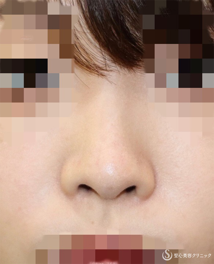 【20代女性・鼻の穴を目立たなく＆鼻筋をスッと】鼻孔縁下降術＋Gメッシュ（術後2週） After 