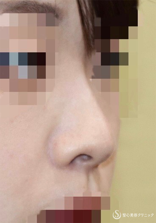 【20代女性・鼻の穴を目立たなく＆鼻筋をスッと】鼻孔縁下降術＋Gメッシュ（術後2週） After 