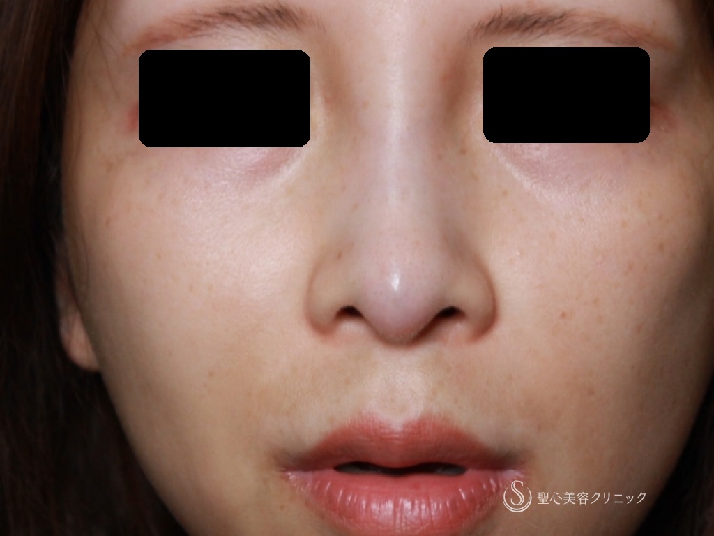 【30代女性・鼻筋をすっきりさせたい】鼻のアクアミド除去+鼻のプロテーゼ+耳介軟骨移植（1ヶ月後） Before 