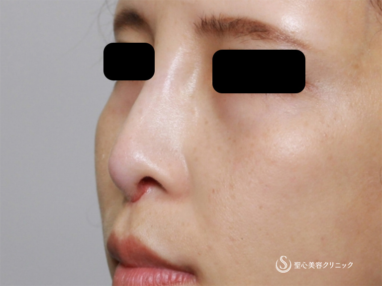 【30代女性・鼻筋をすっきりさせたい】鼻のアクアミド除去+鼻のプロテーゼ+耳介軟骨移植（1ヶ月後） After 