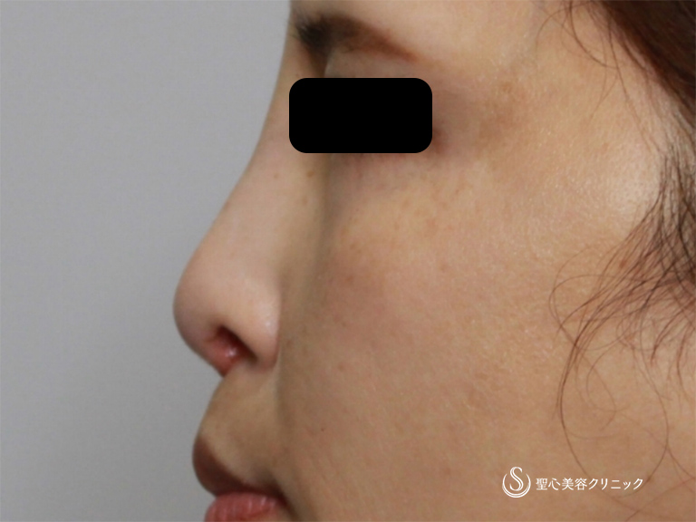 【30代女性・鼻筋をすっきりさせたい】鼻のアクアミド除去+鼻のプロテーゼ+耳介軟骨移植（1ヶ月後） After 