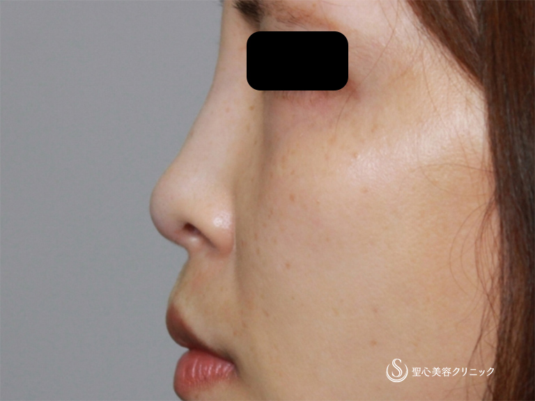 【30代女性・鼻筋をすっきりさせたい】鼻のアクアミド除去+鼻のプロテーゼ+耳介軟骨移植（1ヶ月後） Before 