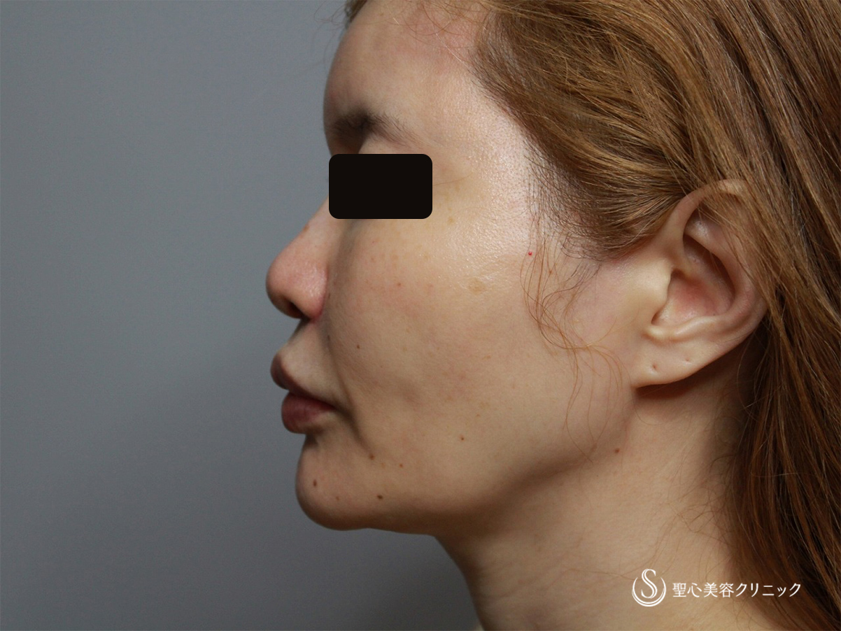 【50代女性・リフトアップでたるみ改善】アンカーDXダブル（こめかみ、頬、顎下）モニター（１か月後） Before 