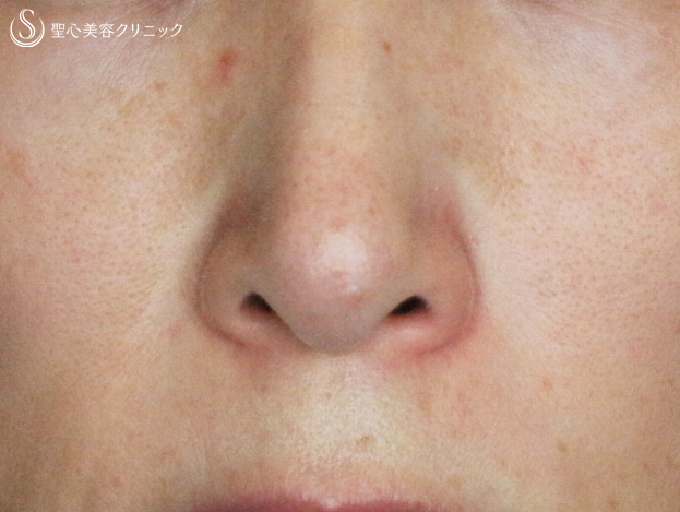 【40代女性・鼻の下の長年の赤み】585Quanta System Q1モニター（3回後） Before 