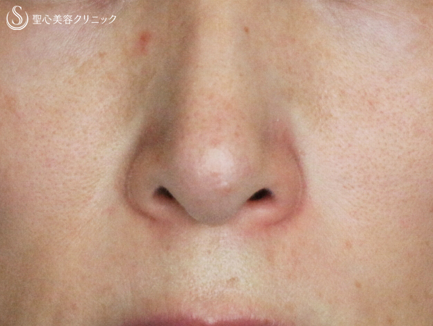 【40代女性・鼻の下の長年の赤み】585Quanta System Q1モニター（3回後） Before 
