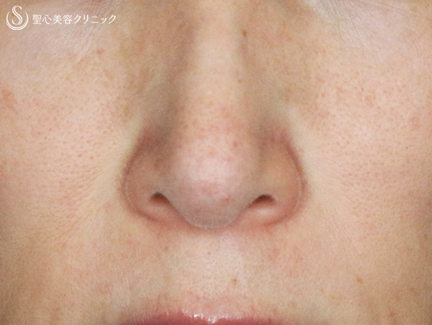 【40代女性・鼻の下の長年の赤み】585Quanta System Q1モニター（3回後） After 
