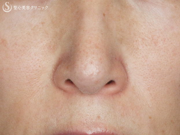 【40代女性・鼻の下の長年の赤み】585Quanta System Q1モニター（3回後） After 