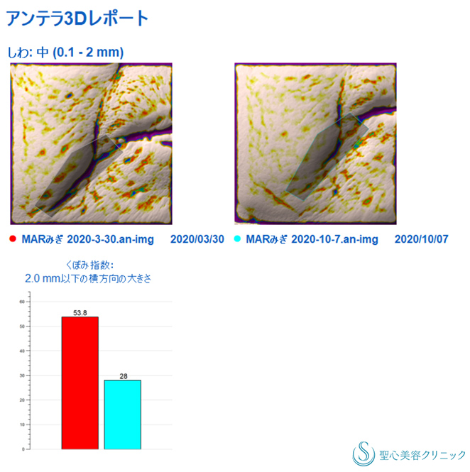 【70代女性・目の下、マリオネットラインの若返り】プレミアムPRP皮膚再生療法（6ヶ月後） After 