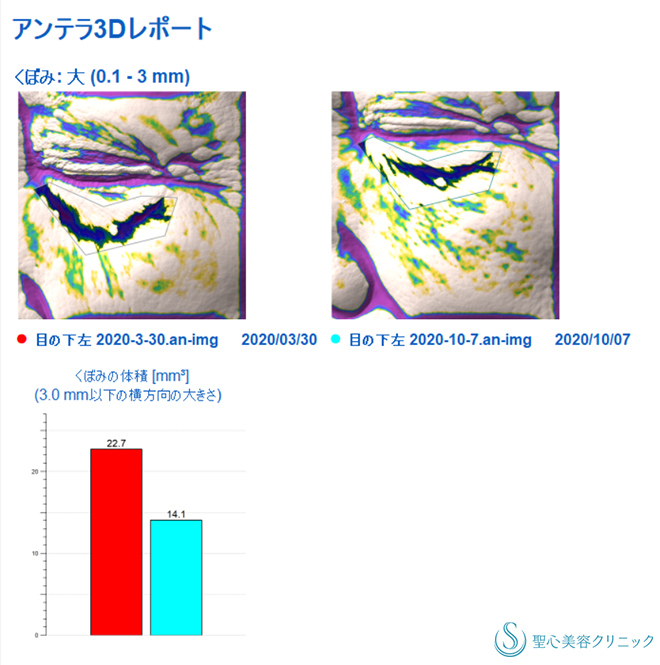 【70代女性・目の下、マリオネットラインの若返り】プレミアムPRP皮膚再生療法（6ヶ月後） After 