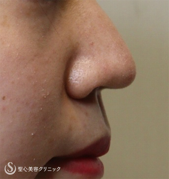 【20代女性・鼻先を細くしたい】鼻尖縮小＋リップリフト（1ヶ月後） Before 