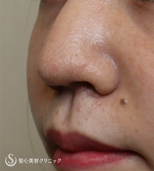 【20代女性・鼻先を細くしたい】鼻尖縮小＋リップリフト（1ヶ月後） Before 