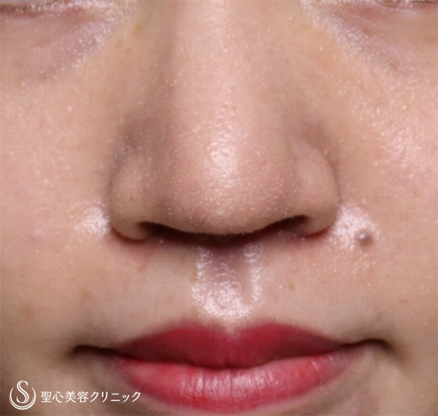 【20代女性・鼻先を細くしたい】鼻尖縮小＋リップリフト（1ヶ月後） After 