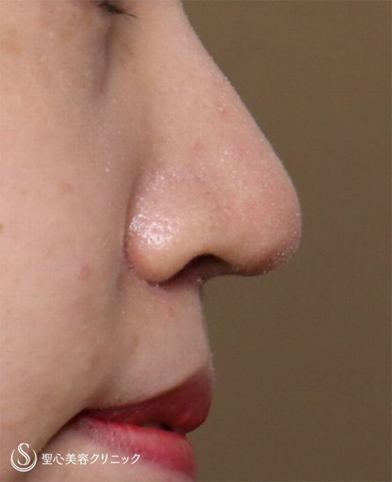 【20代女性・鼻先を細くしたい】鼻尖縮小＋リップリフト（1ヶ月後） After 