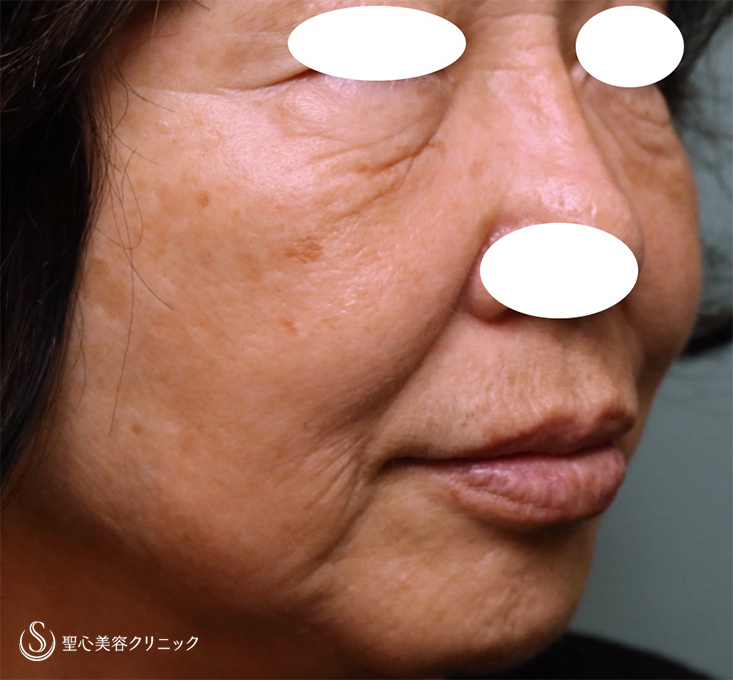 【70代女性・シワと皮膚のたるみ改善】プレミアムPRP皮膚再生療法（1年後） Before 