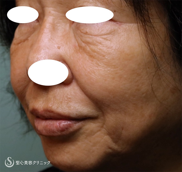 【70代女性・シワと皮膚のたるみ改善】プレミアムPRP皮膚再生療法（1年後） Before 