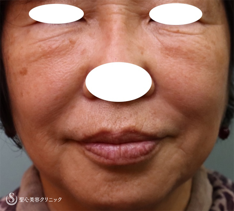【70代女性・シワと皮膚のたるみ改善】プレミアムPRP皮膚再生療法（1年後） After 