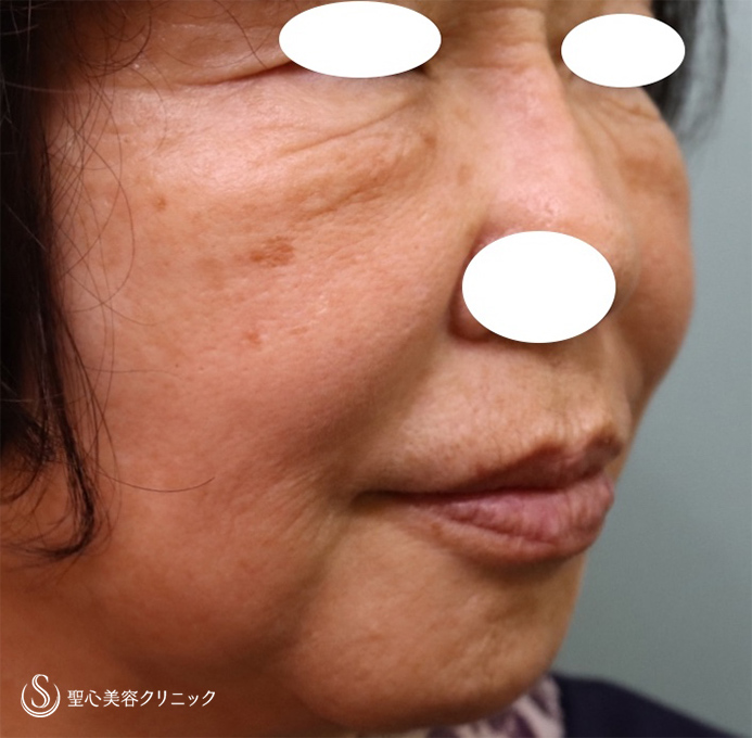 【70代女性・シワと皮膚のたるみ改善】プレミアムPRP皮膚再生療法（1年後） After 