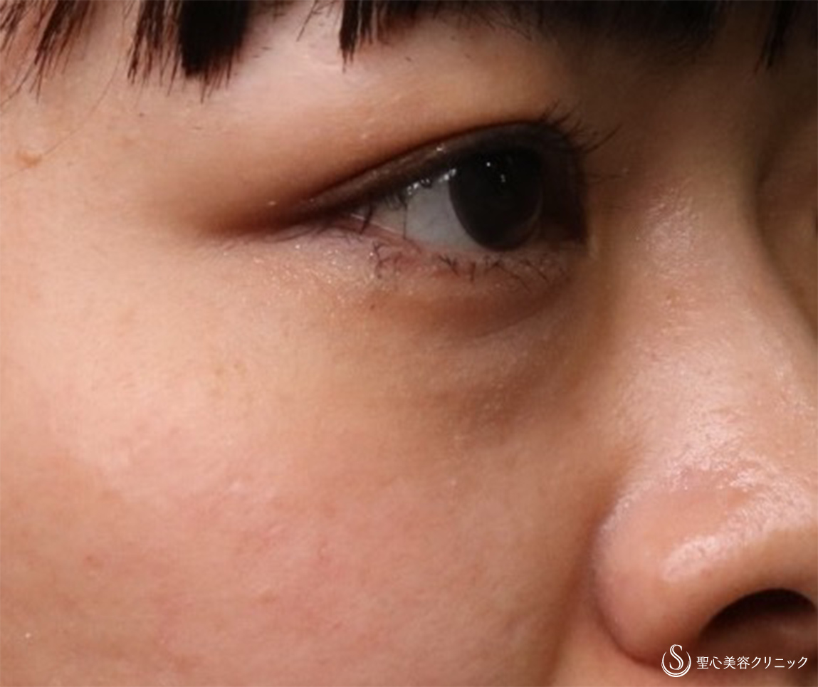 【30代女性・疲れた目元からクマなしに】プレミアムPRP皮膚再生療法（3ヶ月・6ヶ月後） Before 