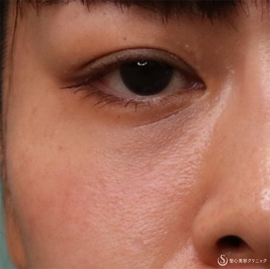 【30代女性・疲れた目元からクマなしに】プレミアムPRP皮膚再生療法（3ヶ月・6ヶ月後） Before 