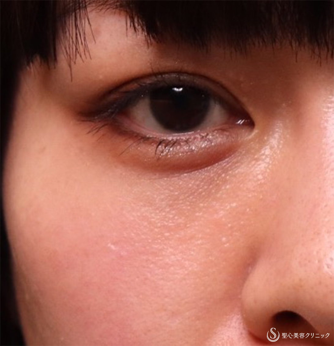 【30代女性・疲れた目元からクマなしに】プレミアムPRP皮膚再生療法（3ヶ月・6ヶ月後） After 