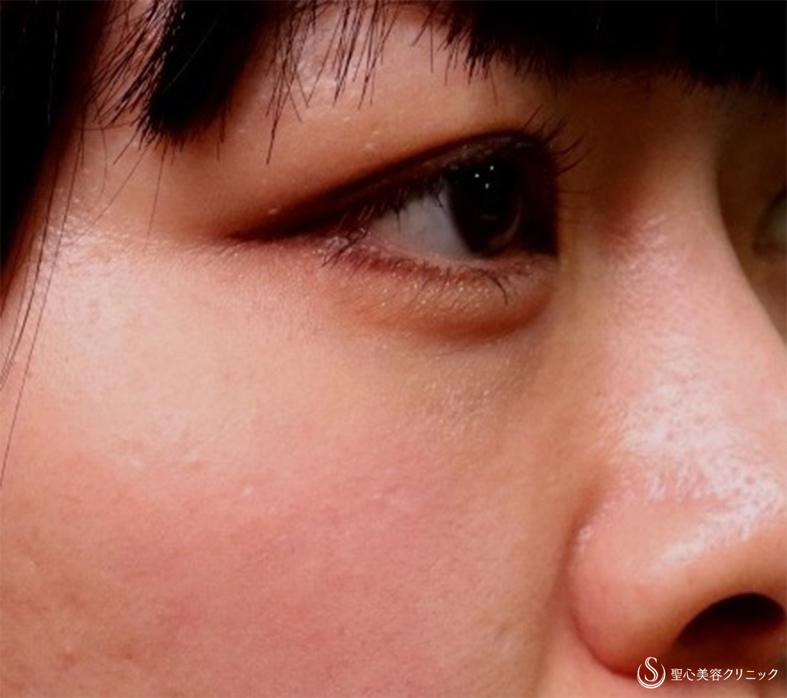 【30代女性・疲れた目元からクマなしに】プレミアムPRP皮膚再生療法（3ヶ月・6ヶ月後） After 