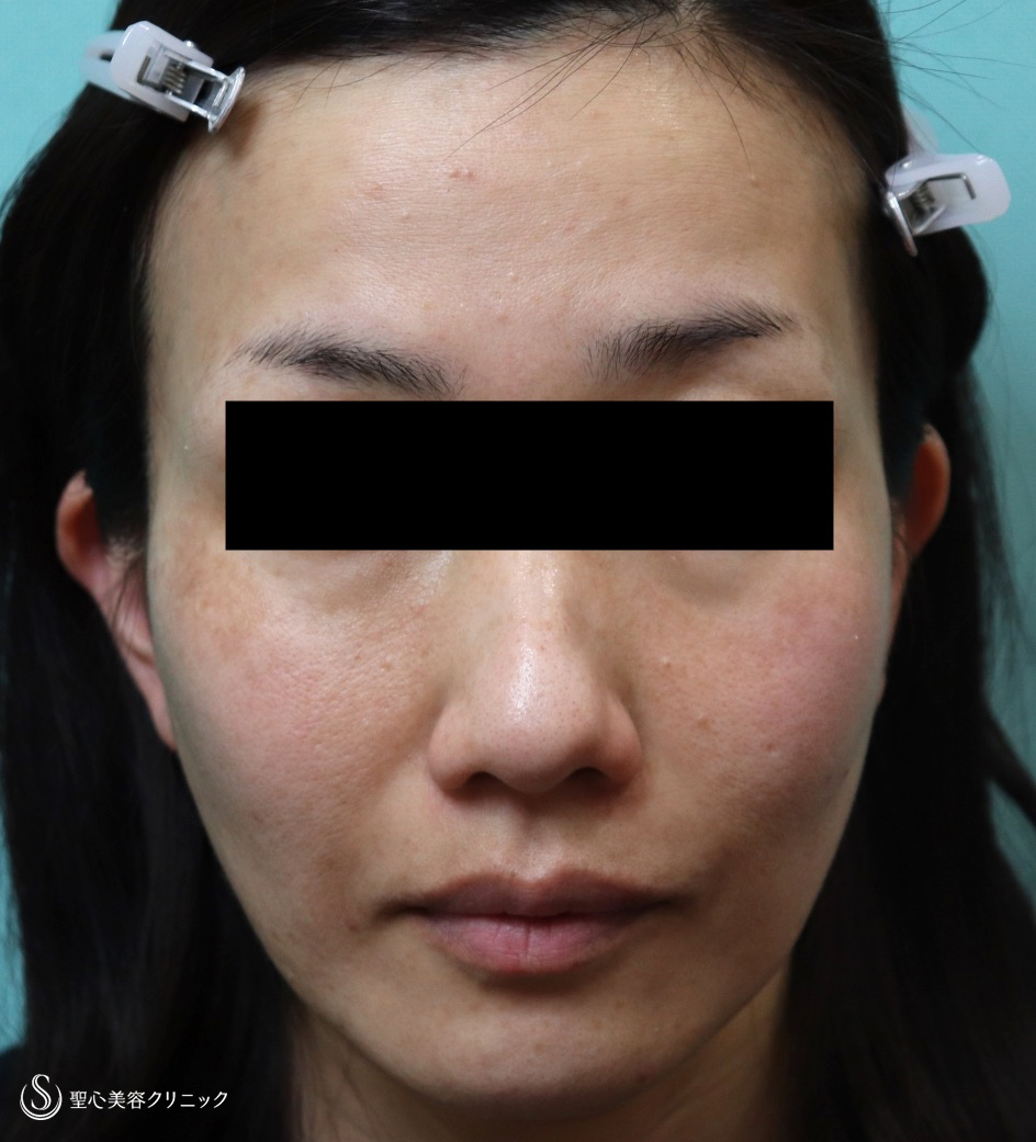 【40代女性・PRPによる若返り】プレミアムPRP皮膚再生療法（追加注入あり）（1年後） After 