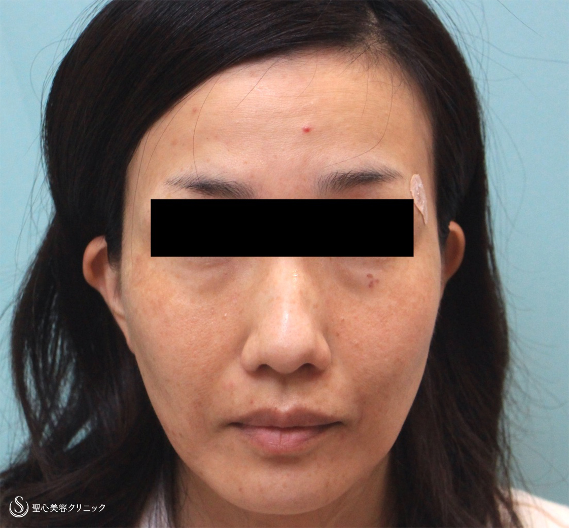 【40代女性・PRPによる若返り】プレミアムPRP皮膚再生療法（追加注入あり）（1年後） Before 