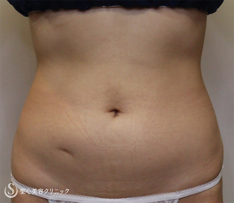 【20代女性・究極に細くなる】ベイザーリポ脂肪吸引（腹部１周）（術後３ヶ月） Before 