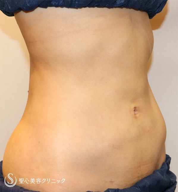 【20代女性・究極に細くなる】ベイザーリポ脂肪吸引（腹部１周）（術後３ヶ月） After 