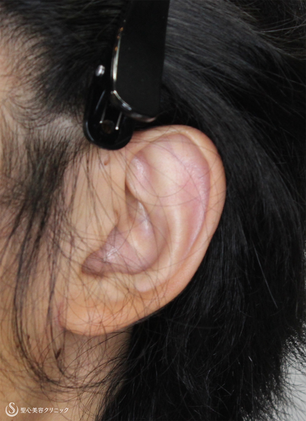 【20代男性・立ち耳を改善！！】立ち耳修正（切開法）（2ヶ月後） Before 