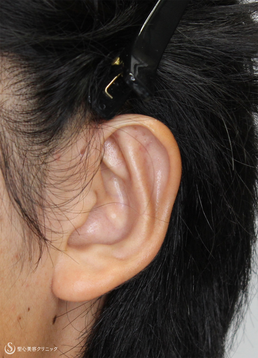 【20代男性・立ち耳を改善！！】立ち耳修正（切開法）（2ヶ月後） After 