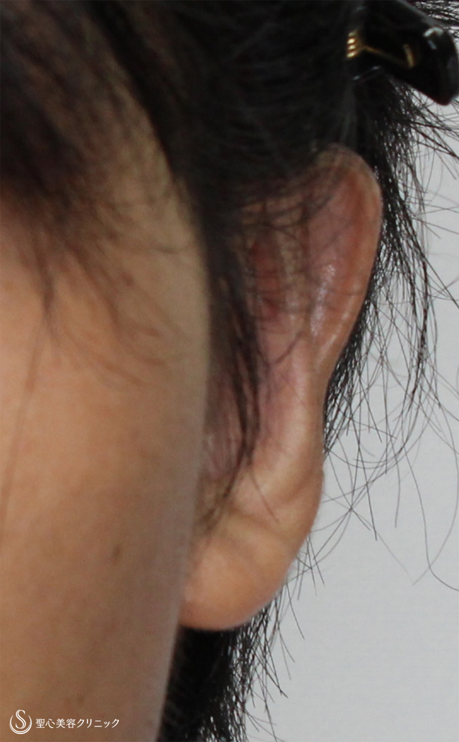 【20代男性・立ち耳を改善！！】立ち耳修正（切開法）（2ヶ月後） After 