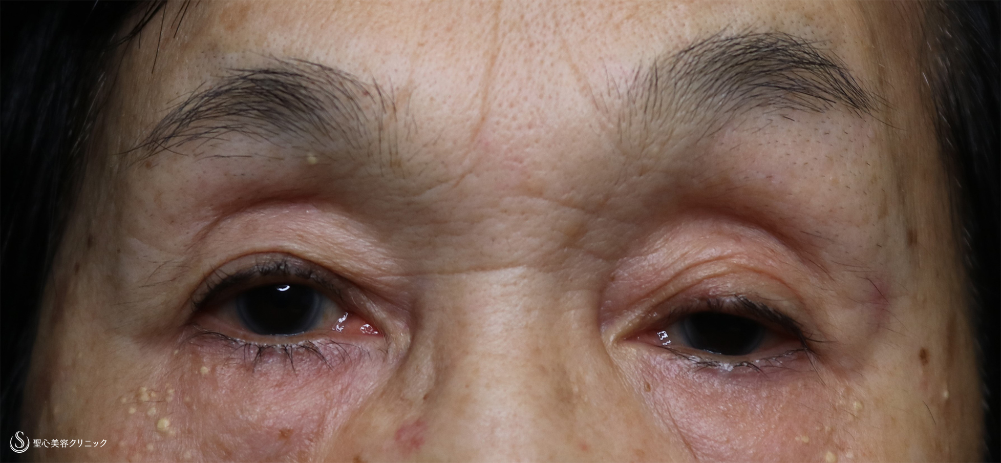 【80代女性・眼瞼下垂】左眼瞼下垂手術（腱膜縫縮法） Before 