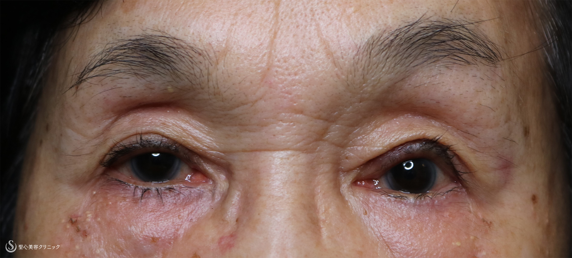 【80代女性・眼瞼下垂】左眼瞼下垂手術（腱膜縫縮法） After 