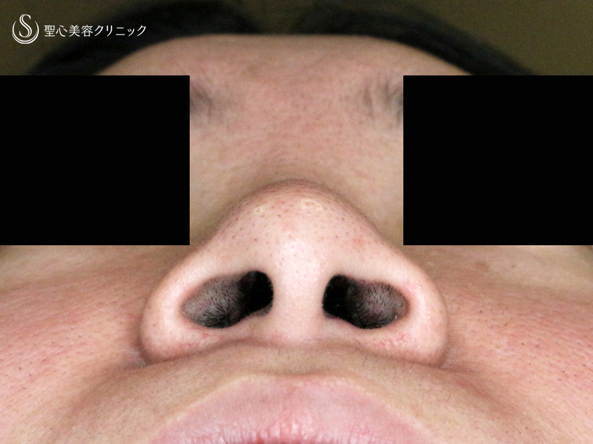 【30代女性・存在感のない「忘れ鼻」に】小鼻縮小術+α法「Ver.4」（1ヶ月後） Before 