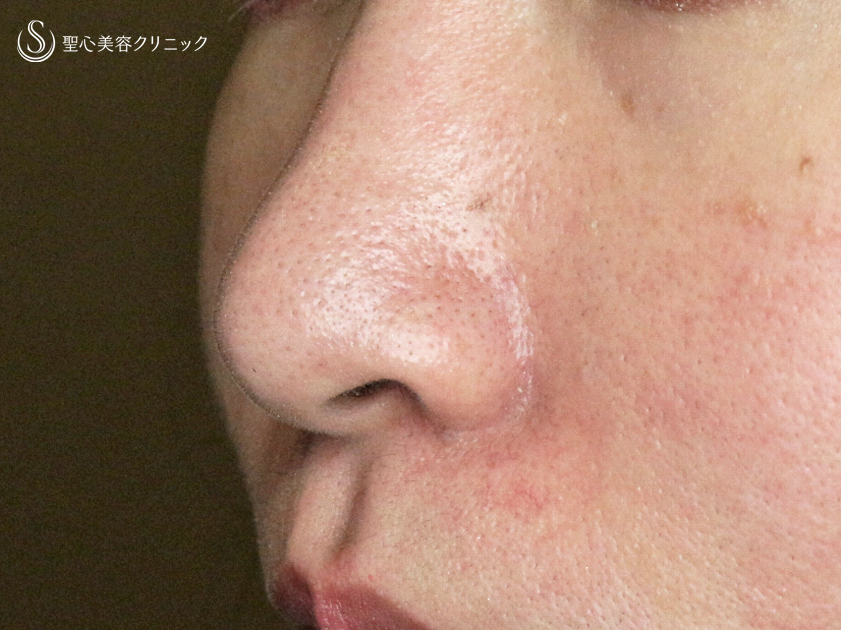 【30代女性・存在感のない「忘れ鼻」に】小鼻縮小術+α法「Ver.4」（1ヶ月後） After 
