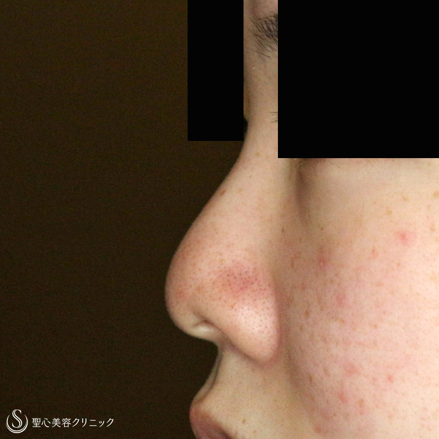 【20代女性・画期的なダンゴ鼻の治療＆鼻尖延長】3D鼻尖用・PCLドーム（1年4ヶ月後） Before 