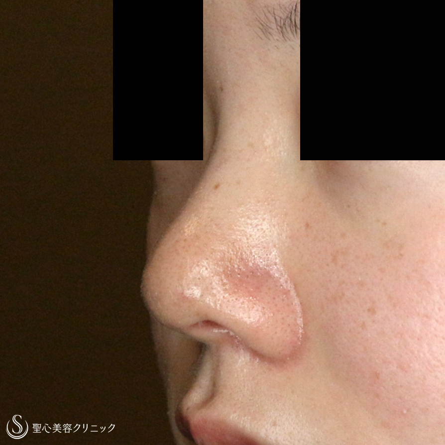 【20代女性・画期的なダンゴ鼻の治療＆鼻尖延長】3D鼻尖用・PCLドーム（1年4ヶ月後） After 