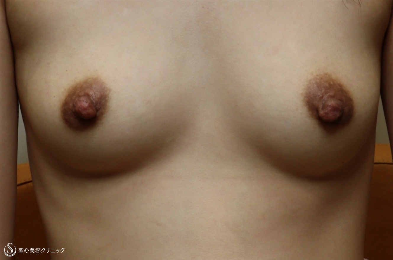 【30代女性・乳首を小さく】乳頭縮小（1ヶ月後） Before 