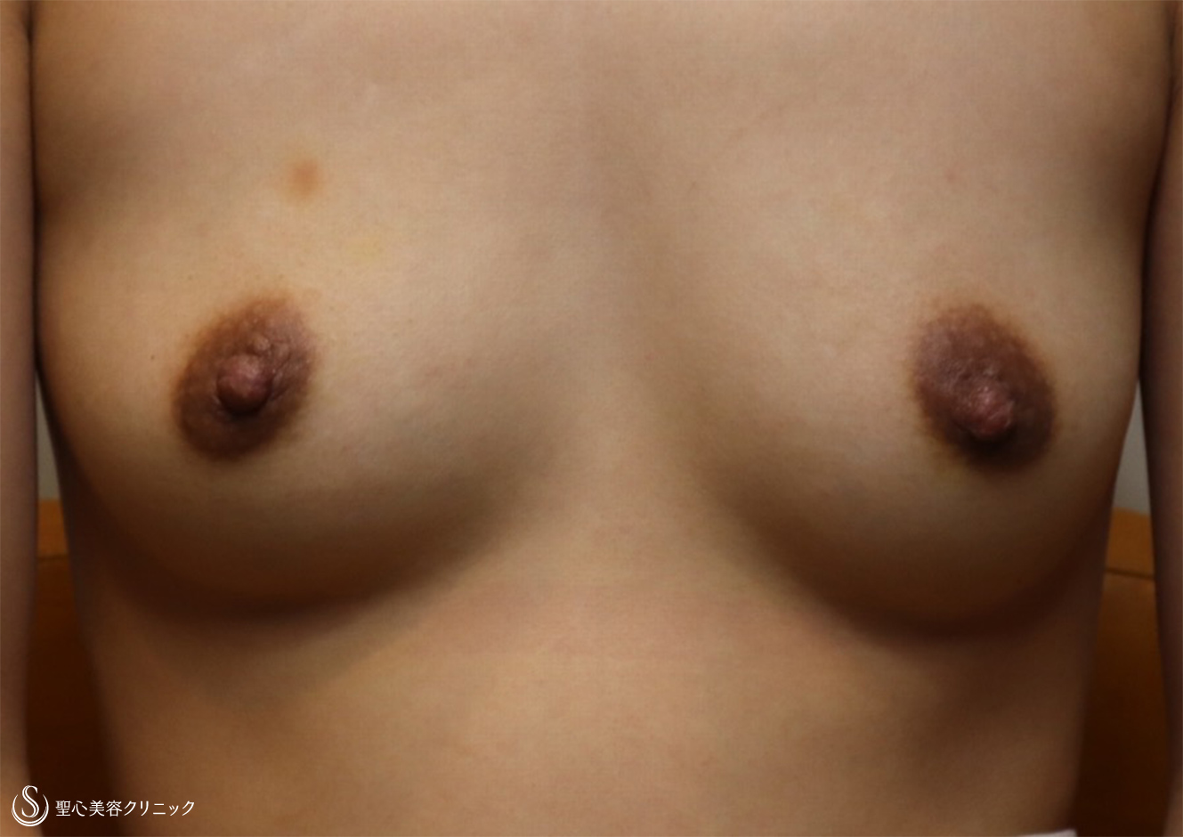 【30代女性・乳首を小さく】乳頭縮小（1ヶ月後） After 