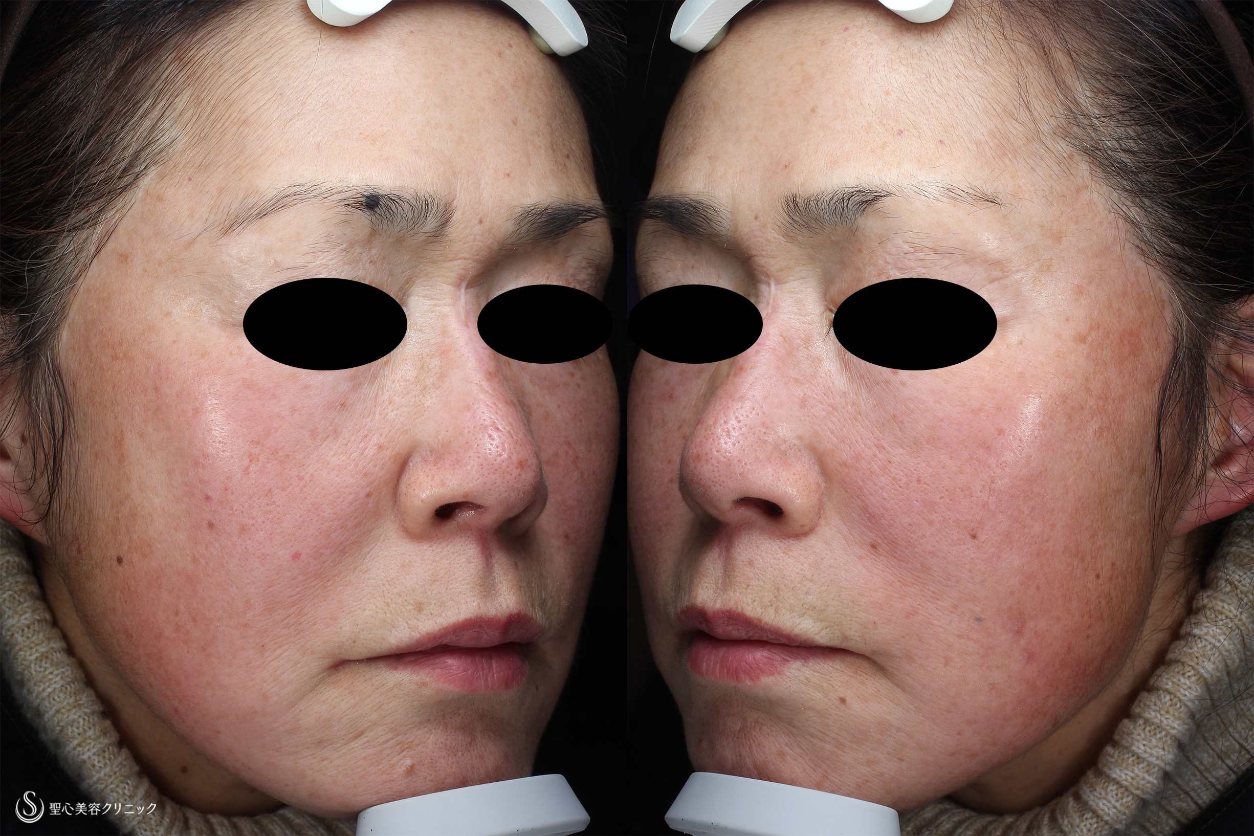 50代女性 しみ くすみ 肌のきめ プレミアムpico肌再生療法 7ヶ月後 症例写真 美容整形 美容外科なら聖心美容クリニック