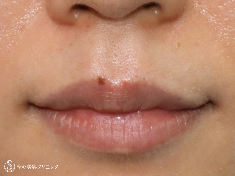 【女性・唇のホクロ】電気凝固法（3ヶ月後） Before 