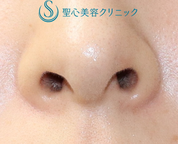【20代女性・鼻の穴の形を小さく整える】鼻孔縁下降術（1ヶ月後） After 