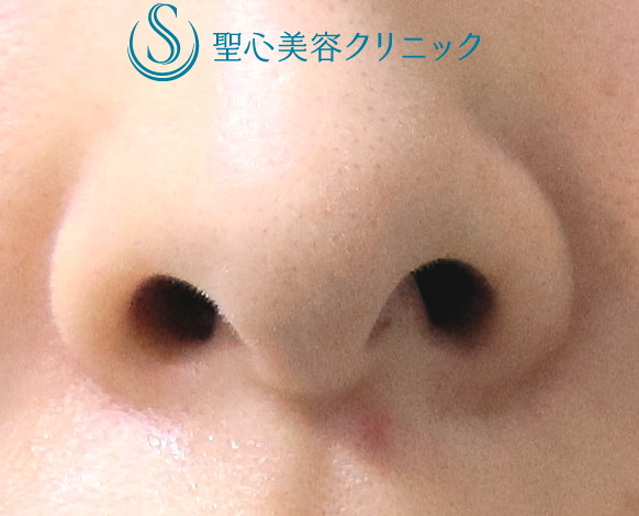 【20代女性・鼻の穴の形を小さく整える】鼻孔縁下降術（1ヶ月後） Before 