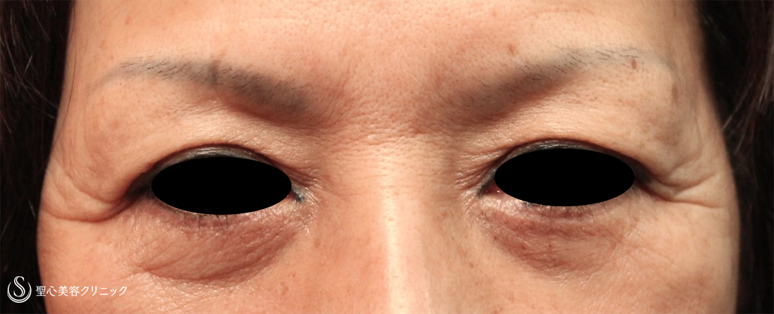 【60代女性・目の下のくま、目の上のたるみ】プレミアムPRP皮膚再生療法、眉下切開（3年7ヶ月後） Before 
