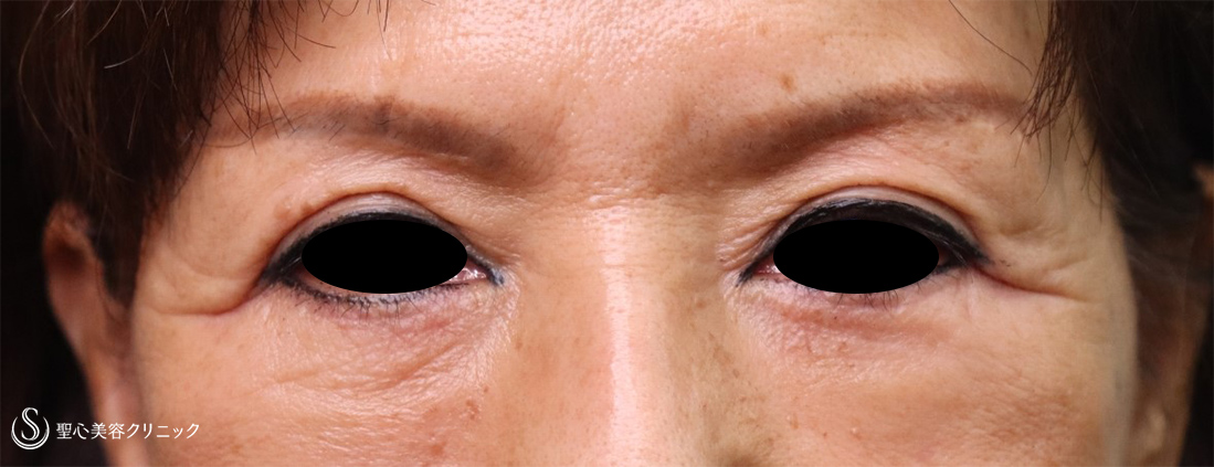 【60代女性・目の下のくま、目の上のたるみ】プレミアムPRP皮膚再生療法、眉下切開（3年7ヶ月後） After 