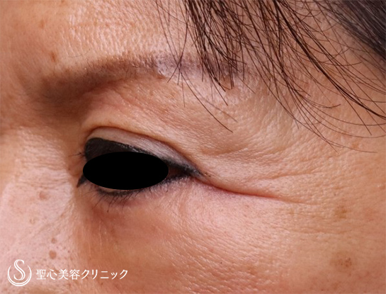 【60代女性・目の下のくま、目の上のたるみ】プレミアムPRP皮膚再生療法、眉下切開（3年7ヶ月後） After 