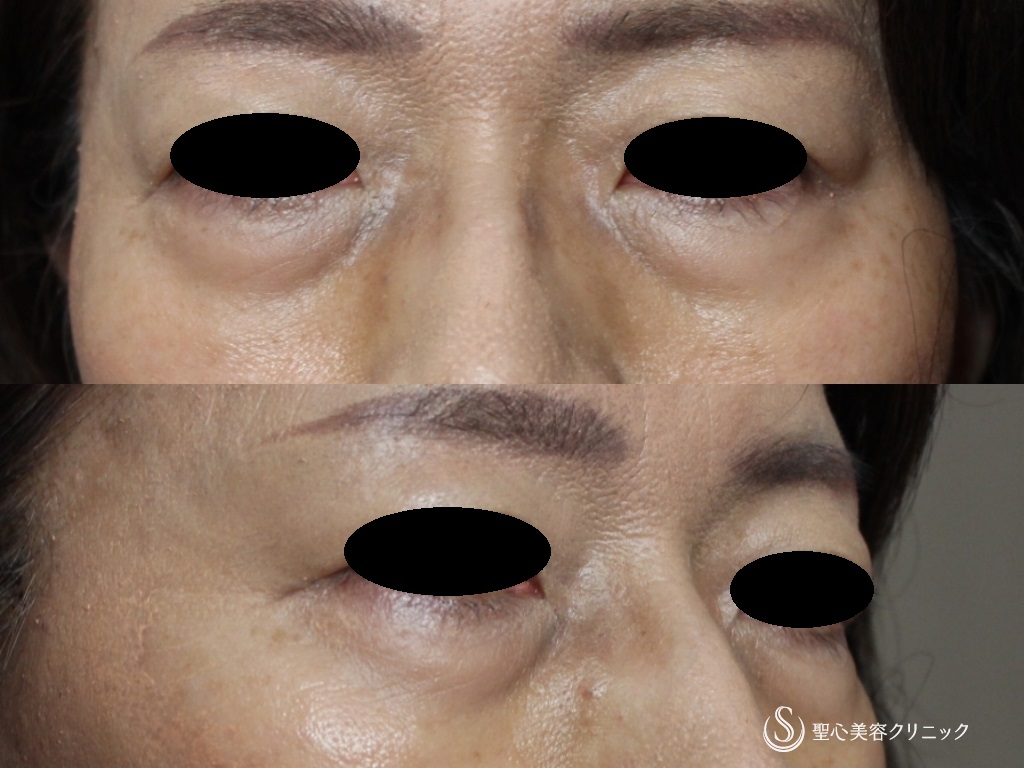【50代女性・目の下のたるみ、膨らみの改善】プレミアムPRP皮膚再生療法（1年後） Before 
