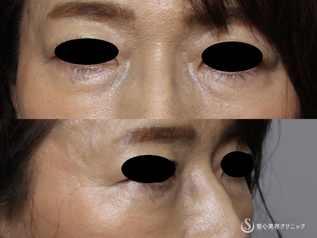 【50代女性・目の下のたるみ、膨らみの改善】プレミアムPRP皮膚再生療法（1年後） After 