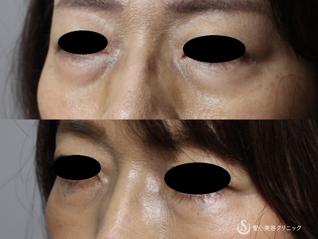 【50代女性・目の下のたるみ、膨らみの改善】プレミアムPRP皮膚再生療法（1年後） After 